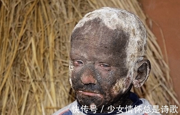 身体|小男孩11岁身体开始硬化成石头?专家:完全束手无策!