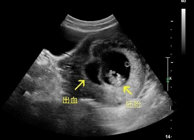 攻略|怀孕多久做B超检查比较好？这份孕早期检查攻略，孕妈们查收学习