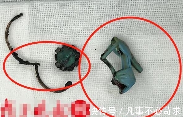 父母|8岁男孩耳朵疼痛难忍,父母带孩子去检查,取出的东西让爸妈崩溃