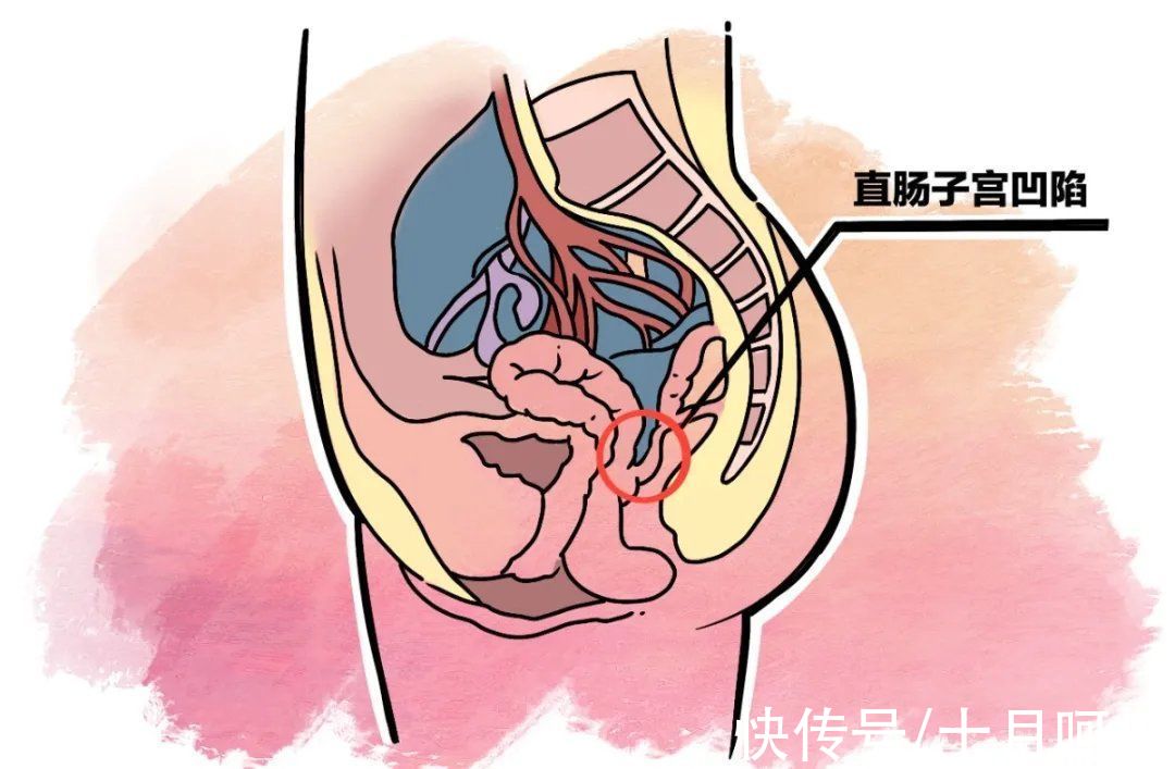 积液|这种妇科病不用去医院治！白花钱还还受罪