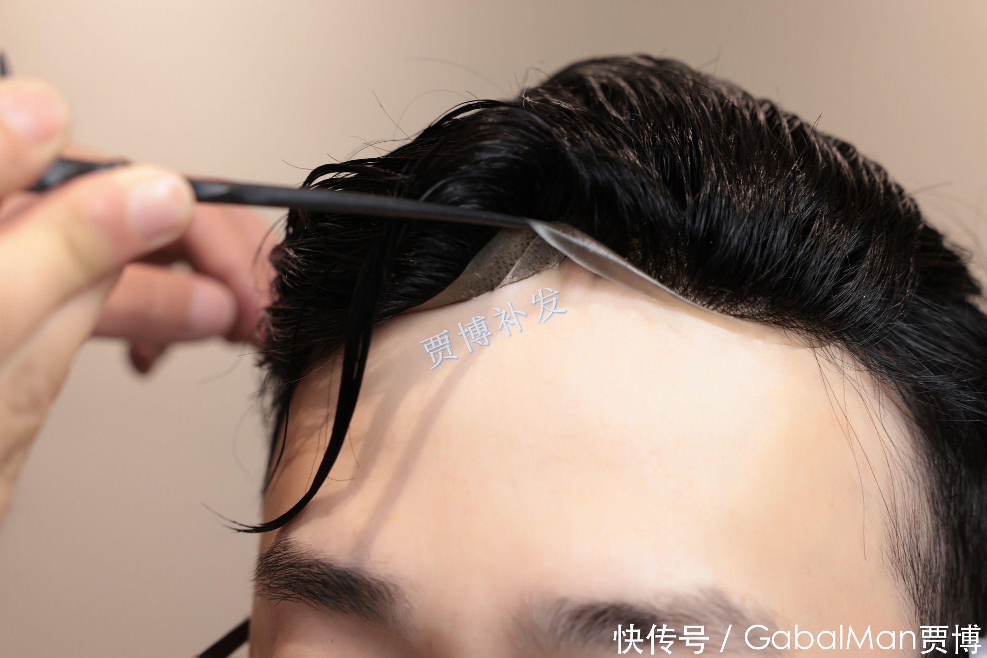 发际线脱发|60分钟拯救你的发际线!告别高额头,让你更显年轻