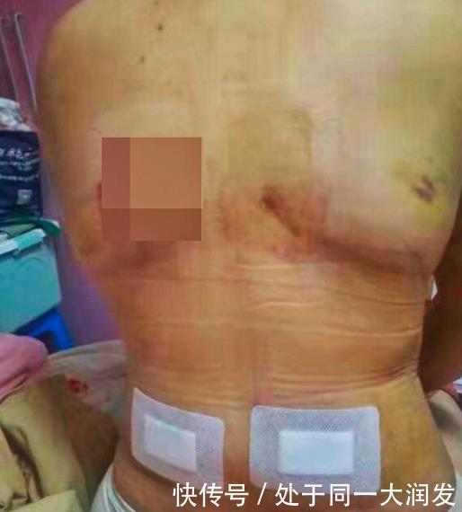 创口|女子去医美抽脂,背部创口溃烂缝不了针,竟仍选择做双腿吸脂手术