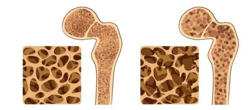 雌激素|女性体内雌激素“枯竭”会有何表现？女性朋友不妨对照自查看看