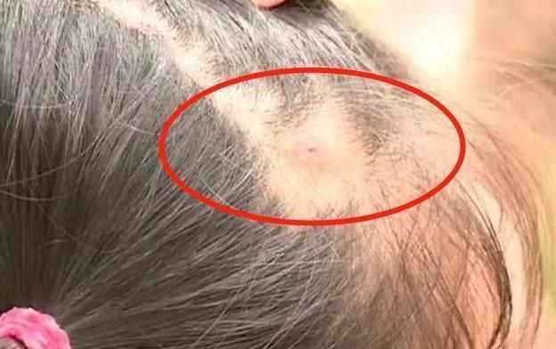 医院|梳头发现''小米粒'',宝爸急忙带女儿去医院,医生:还好来得及时