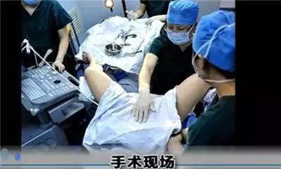 做试管婴儿的全部过程（附图解），看着都疼，可怜天下父母心