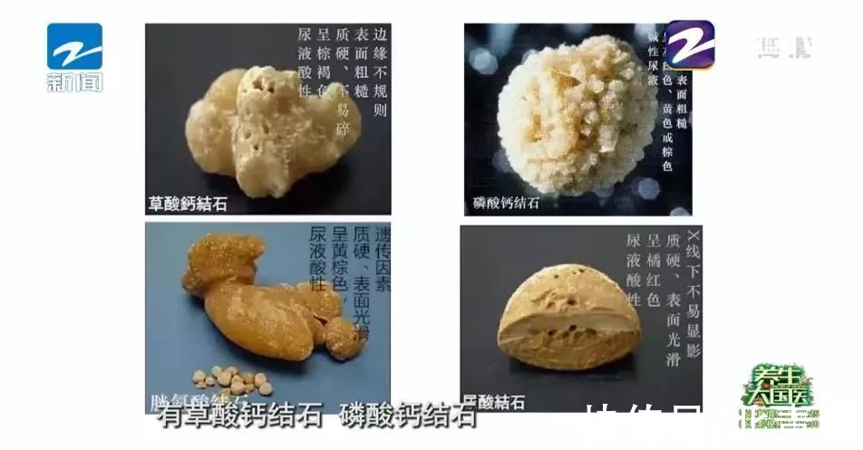 肾绞痛|肾结石究竟是如何形成的？医生劝告：4个诱因及时避开，切莫贪嘴多吃