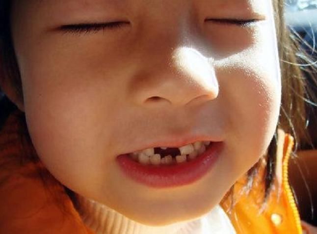 孩子|6岁男娃长“双层牙”,老人的“坏习惯”害了娃,你家有这习惯吗