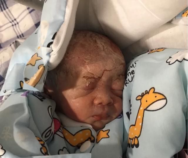 双胞胎|早产双胞胎兄弟,刚出生时瘦如干瘪小老头,11天颜值逆袭变成萌娃