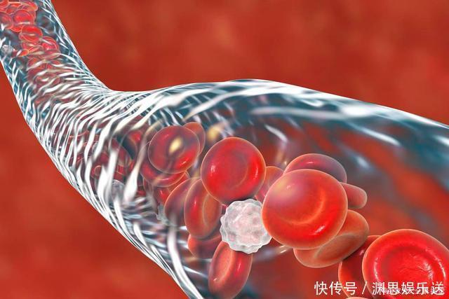  脑梗的“祸根”被揪出，原来不是抽烟喝酒，而是它，麻烦正确对待