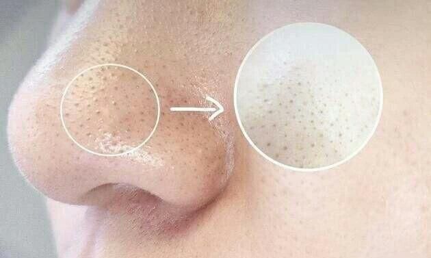 床上螨虫成窝,家里老人小孩老过敏,教你1个土法子,让螨虫消失