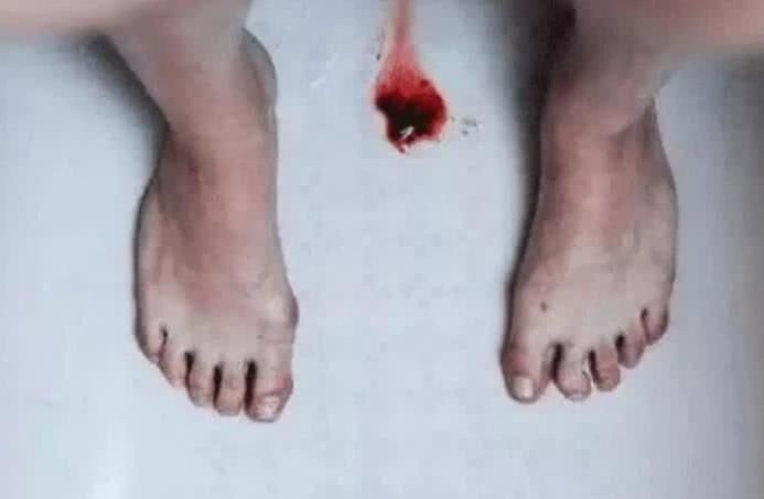 女孩子|女孩子瞄一眼内“裤”若出现这3印记，八成是宫颈癌“兴妖作怪”