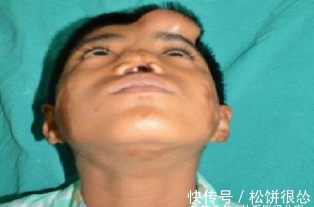 鼻子|国外小男孩鼻子长在额头上,看了他的经历,真是坚强的表率