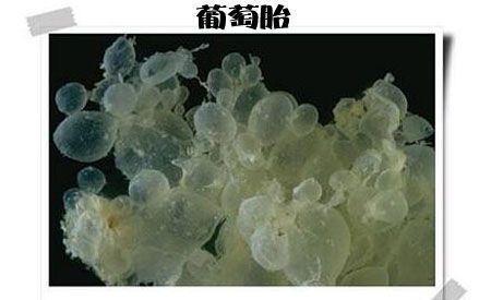 医生|怀孕女子嫌产检麻烦,5个月后才到医院,结果肚子里全是小蝌蚪