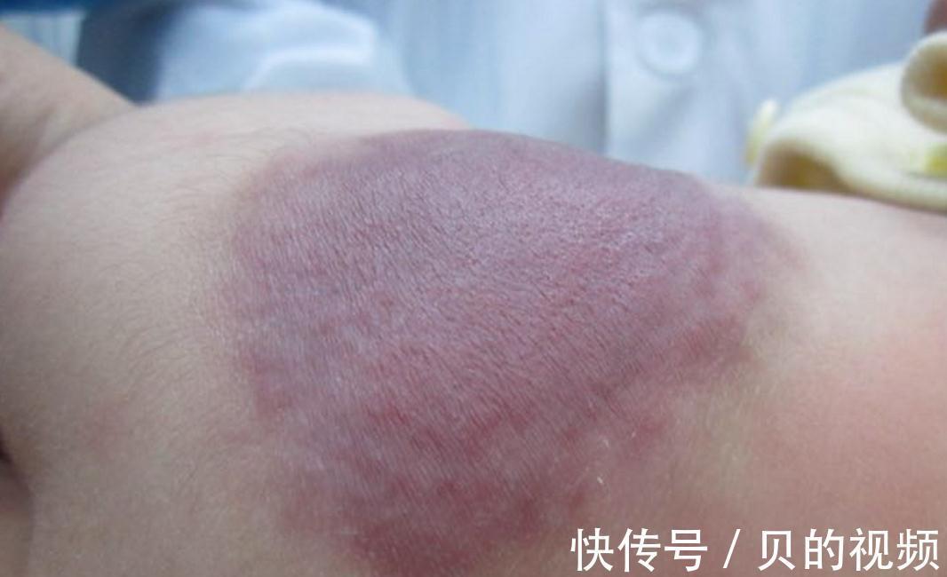 孕期|这三种孕妈容易生出“胎记宝宝”,和孕期行为习惯有关,多上点心