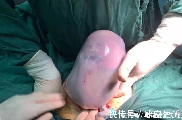 分娩|90后孕妇生下“带壳宝宝”,丈夫情绪失控,医生却说是个幸运儿