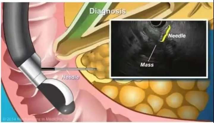 胰腺|浙中医大二院开展首例超声内镜引导下细针穿刺抽吸术，一根细针辨病因