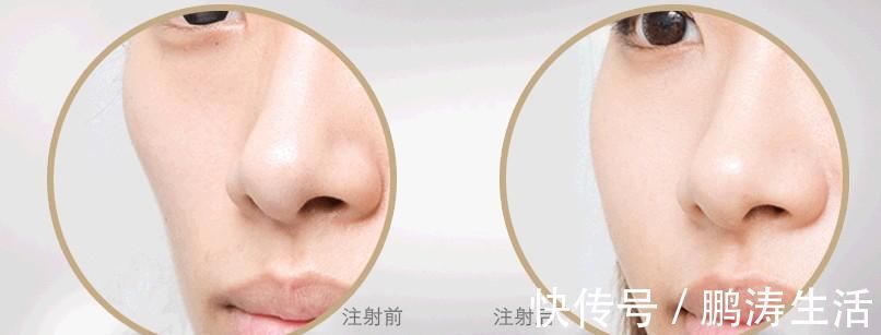 护理 面部脂肪填充能维持多久术后护理很重要