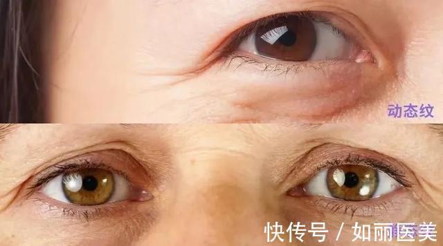 胶原纤维 跟风做的医美项目没有用?选对很重要!