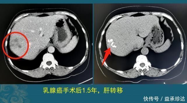 放化疗|查出癌症不放疗不化疗,保持良好心态吃喝玩乐,能扛过去吗