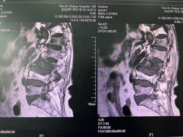 西青医院老年病科与脊柱外科联合为高龄腰椎骨折患者提供“一站式”诊疗服务|医疗动态| 患者