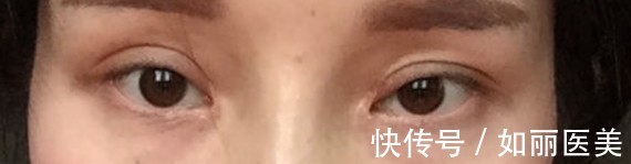 手术 什么样的双眼皮手术意味着失败了?术后多久才能进行二次修复?看完这篇,你就知道啦~