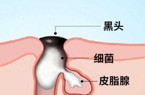 有黑头、长痘痘怎么办？挤掉是下下策，这个方法不疼还省钱