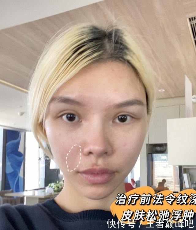 紧致 面部抗衰老,选热玛吉还是线雕提升!