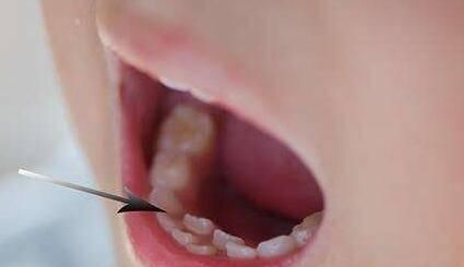 牙齿|吃的太“好”了医院每天接诊20多个双排牙孩子,家长别再这样喂了