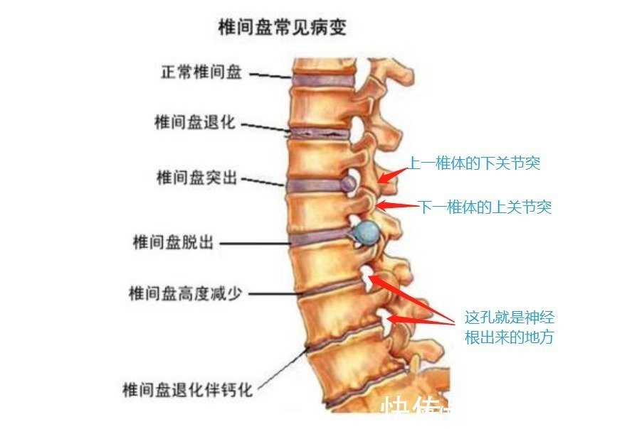 腰腿疼|腰间盘突出压迫神经了，腰腿疼有什么好的治疗方法？医生为您介绍