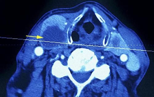 榴莲|女子查出甲状腺结节，半年后转癌？医生：这3种水果可不能多吃