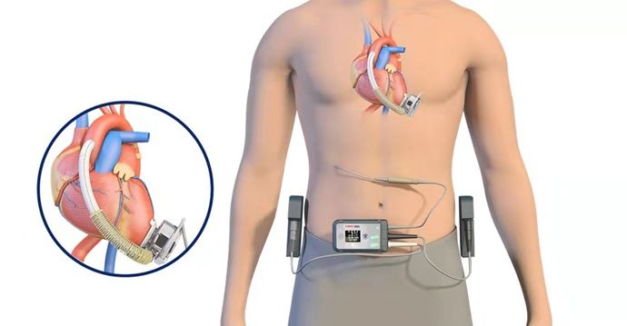 v国内首款全磁悬浮式人工心脏获批上市，百洋投资高精尖医疗赛道布局进入收获期