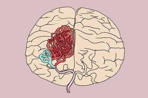 血压|血压多高可能引发脑出血?医生给出参考值,高血压患者需留意