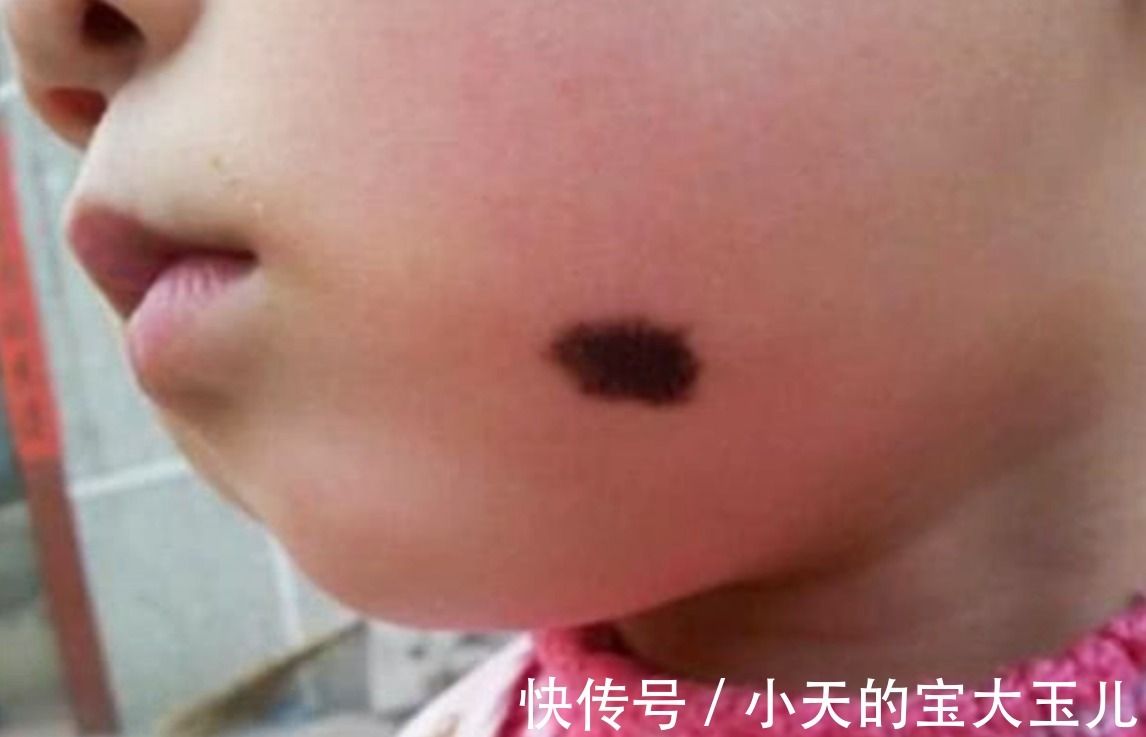 化妆品|婴儿身上为什么会有胎记?资深医生说出原因,与“孕期行为”有关