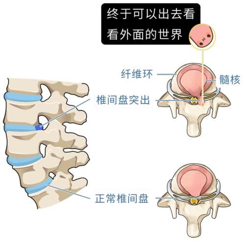 这5个动作是在给腰椎“上刑”，现在意识到还不晚