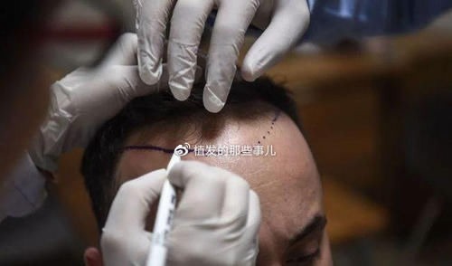 移植 植发科普植发原理?带你揭秘植发手术完整流程