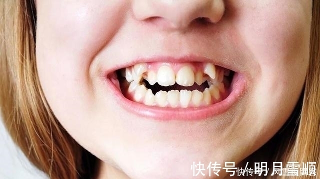 妈妈|17岁孩子长尖牙,妈妈以为是假的,亲手摸过后吐槽:像“吸血鬼”