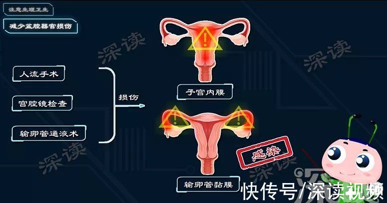 病原體|性生活過頻、人流手術會引發盆腔炎？生活中哪些事易招惹盆腔炎？