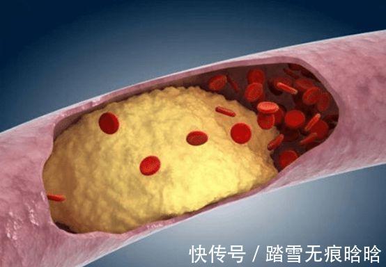 热量|高脂血症容易盯上谁?谨记预防高血脂的“7要点4要素”
