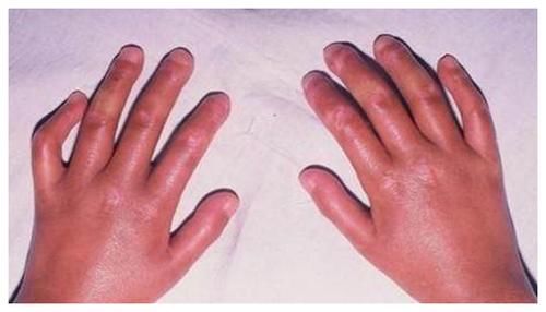 关节|“它”并不是癌症，但“它”会让人生不如死，切记要小心！