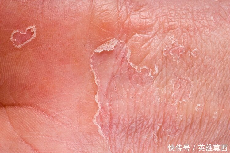 发作|湿疹反复发作奇痒难耐中医给出两种治疗方法,可有效止痒治湿疹