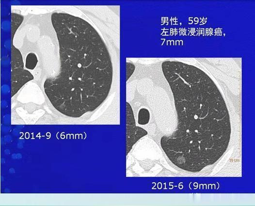 结节|两个肺癌病人都拖了2年才治疗,一个治愈,一个扩散了