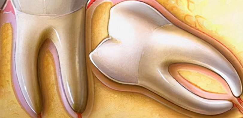 智齿|【科普健康】智齿一定要拔吗？出现这种情况，请及时拔掉智齿