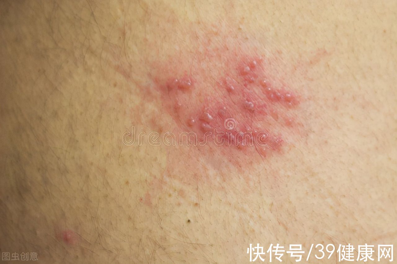 疫苗|有一种剧痛叫“带状疱疹”，劝告：5类人需尤其当心，可接种疫苗