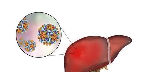  食疗方|脂肪肝不用怕，1个家用食疗方，“刮走”多余脂肪，养好肝脏