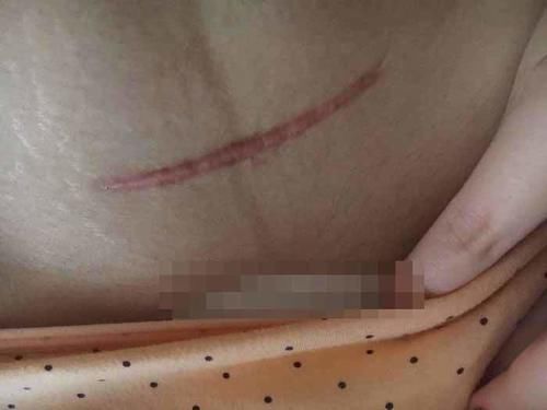 子宫|剖腹产没半年又怀孕，孕30周后子宫破裂，大人保住了孩子却没了