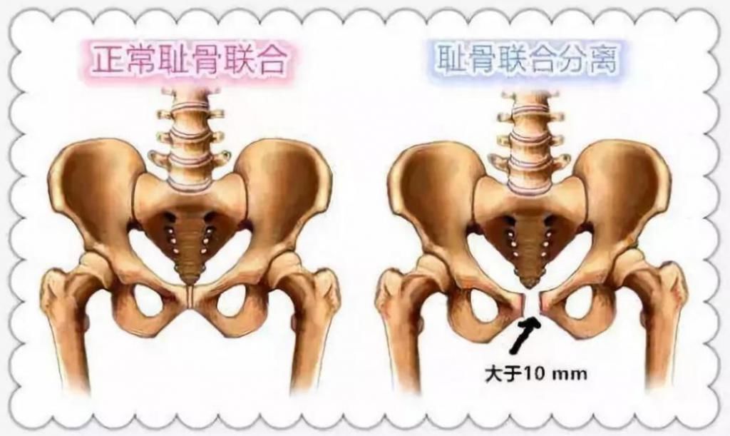 怀老二|孕晚期有一种“痛”很难熬,4类孕妈更容易中招,比分娩更可怕