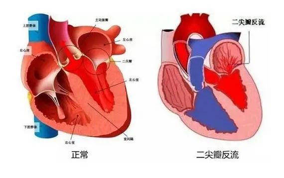 ecmo|潍坊市人民医院顺利完成一例体外膜肺氧合辅助下二尖瓣机械瓣置换手术