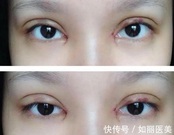 肉条 做双眼皮手术很有可能会产生肉条？你还是会割双眼皮吗