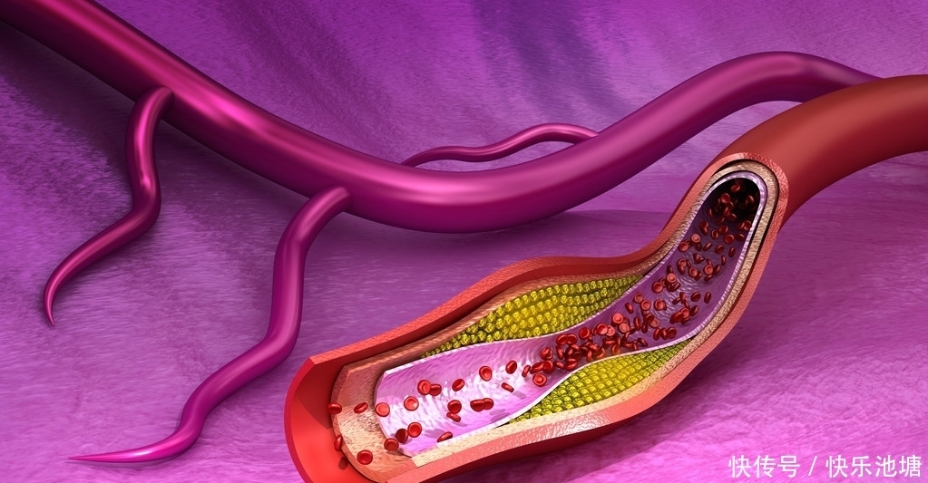 血栓发出的第一个信号,常常是疼痛,45岁以后你该去检查血管