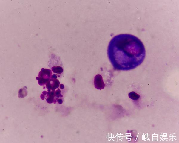 前列腺癌|癌症并非等于绝症，有4种癌就算到了晚期，也有治愈的可能